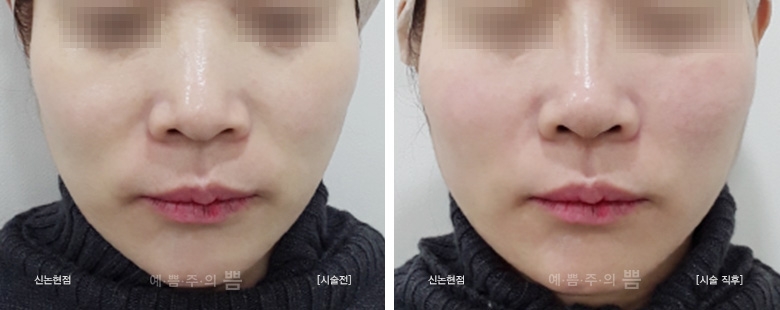 신논현점_하이코+실리프팅