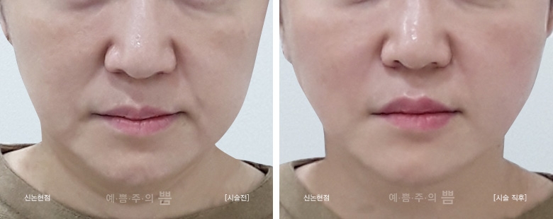 신논현점_실리프팅