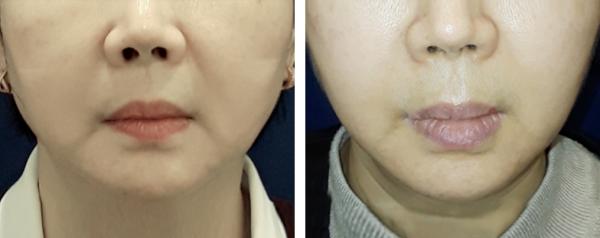건대점_인모드,리니어펌
